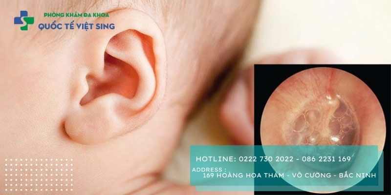 Nguyên nhân viêm tai giữa cấp tính ở trẻ em