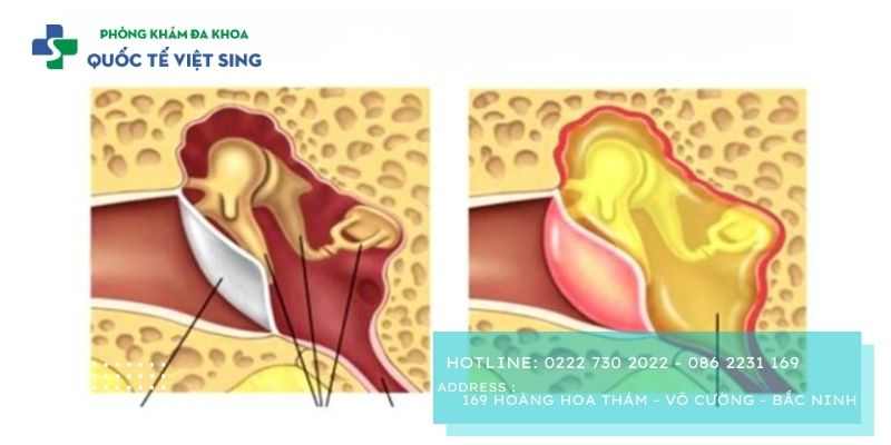 Viêm tai giữ cấp tình là gì?